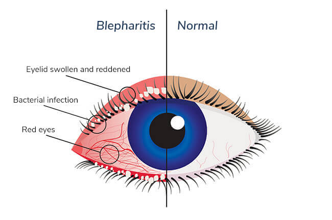 Blepharitis Houston Texas | Eye Exam Houston TX | Houston Eye